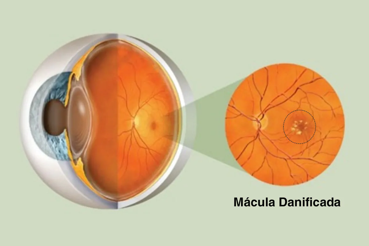 O que é a Degeneração Macular Relacionada à Idade (DMRI)?