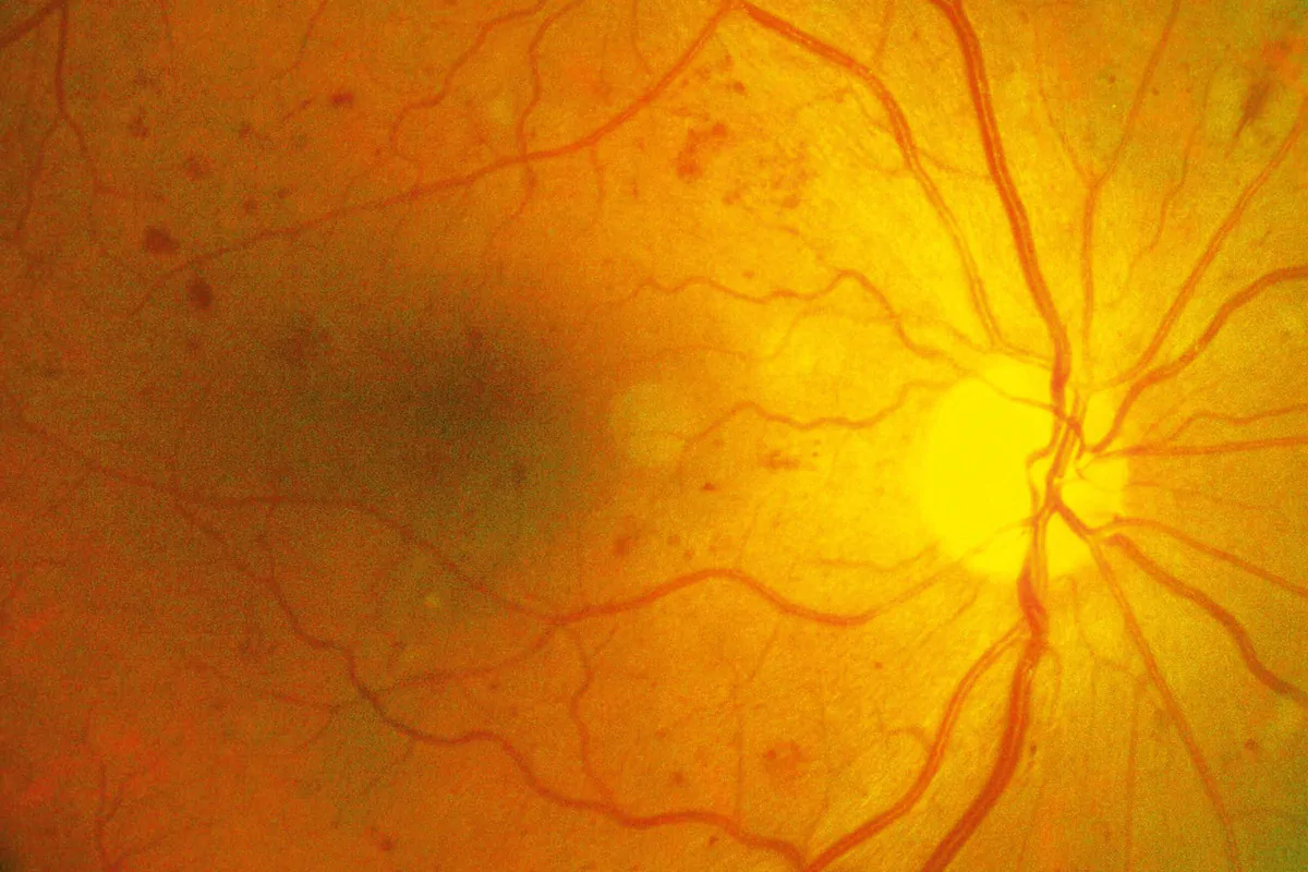 Retinopatia Diabética – A Visão do Paciente Diabético em Risco