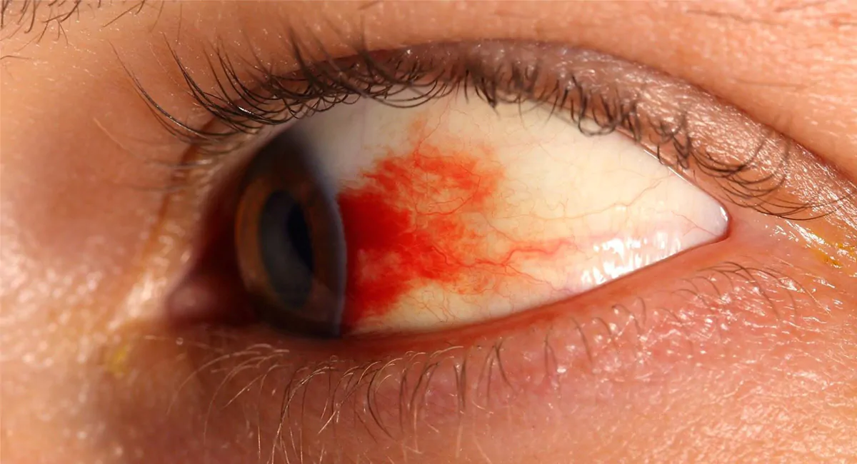 Retinopatia Diabética