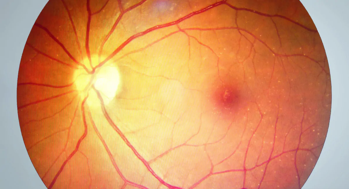 Buraco Macular