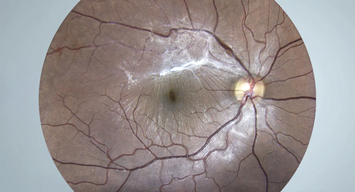 Membrana Epirretiniana