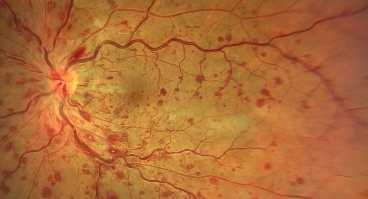 Oclusão Venosa da Retina