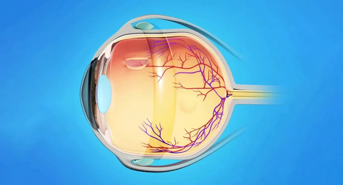 Retinopexia com Introflexão Escleral